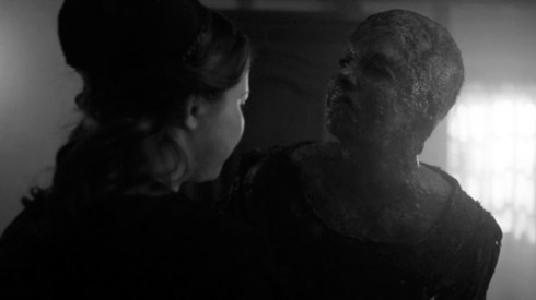 Fig 42 - Sammi Hanratty and the deformed from burning Elise Eberle